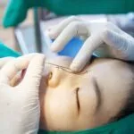Phẫu thuật nâng mũi 3 3