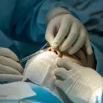 Phẫu thuật nâng mũi 4 4