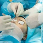 Phẫu thuật nâng mũi 5 5