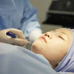 Phẫu thuật độn cằm 3 a2 1 1