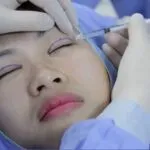 Phẫu thuật thẩm mỹ mắt 5 b4