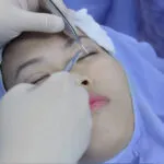 Phẫu thuật thẩm mỹ mắt 6 b5