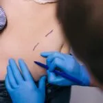 Phẫu thuật hút mỡ bụng 4 t3