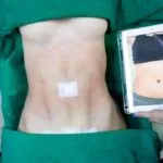 Phẫu thuật hút mỡ bụng 6 t5