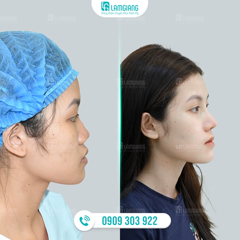 Hình ảnh trước và sau khi nâng mũi cấu trúc mới tại Phòng khám Lam Giang
