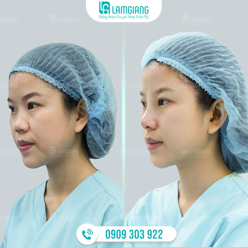 Hình ảnh trước và sau khi nâng mũi cấu trúc sụn sườn tại Phòng khám Lam Giang