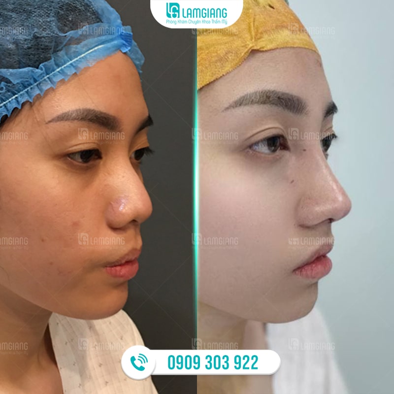 Hình ảnh trước và sau khi nâng mũi cấu trúc sụn sườn tại Phòng khám Lam Giang