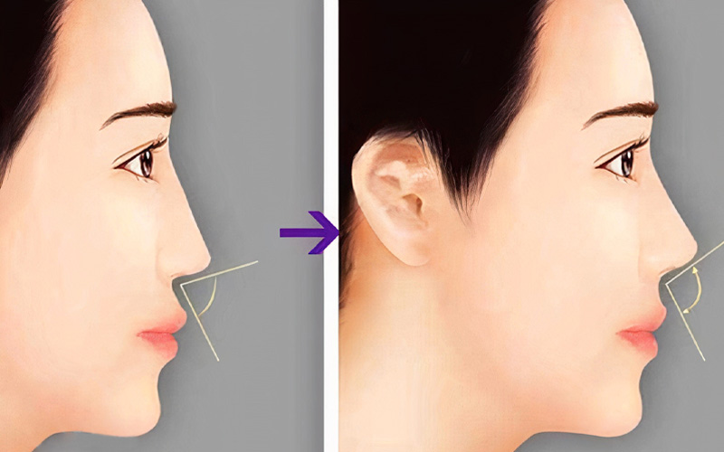 Ưu điểm của công nghệ nâng mũi cấu trúc sụn sườn
