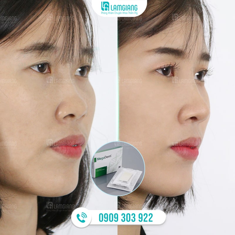 Nâng Mũi Bọc Sụn Megaderm Và Những Điều Cần Biết 3 Hình ảnh trước và sau khi khách nâng mũi bọc sụn Megaderm tại Thẩm mỹ Lam Giang