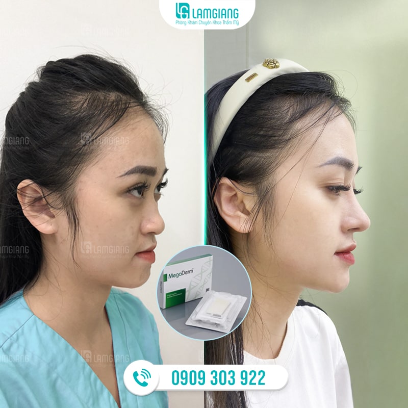 Nâng Mũi Bọc Sụn Megaderm Và Những Điều Cần Biết 4 Hình ảnh trước và sau khi khách nâng mũi bọc sụn Megaderm tại Thẩm mỹ Lam Giang