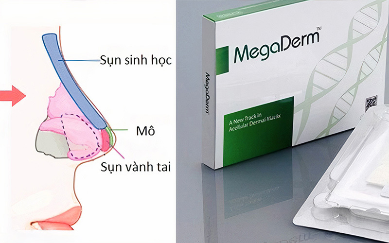 Nâng Mũi Bọc Sụn Megaderm Và Những Điều Cần Biết 1 Bọc sụn Megaderm là gì?