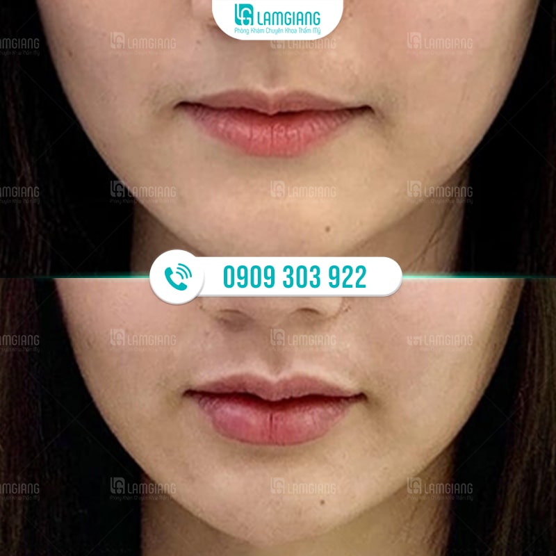 Tạo Hình Môi Trái Tim - Cho Đôi Môi Căng Mọng Quyến Rũ 4 Hình ảnh trước và sau khi khách hàng thực hiện tạo hình môi tại Thẩm mỹ Lam Giang