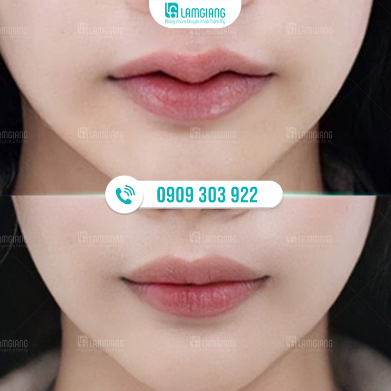 Tạo Hình Môi Trái Tim - Cho Đôi Môi Căng Mọng Quyến Rũ 5 Hình ảnh trước và sau khi khách hàng thực hiện tạo hình môi tại Thẩm mỹ Lam Giang