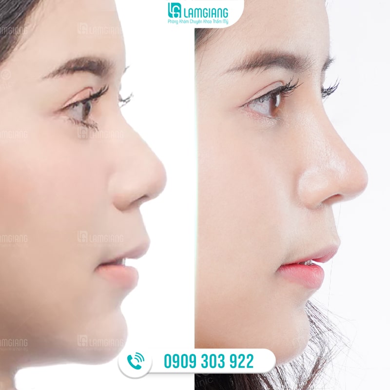 Hình ảnh trước và sau khi nâng mũi cấu trúc sụn sườn tại Phòng khám Lam Giang