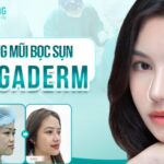 Vì sao nâng mũi bọc sụn Megaderm tạo cơn sốt trong làm đẹp?